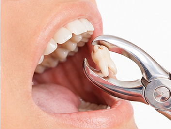 Cirugías Dentales