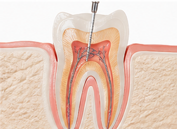 Endodoncia