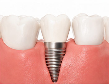Implantes Dentales