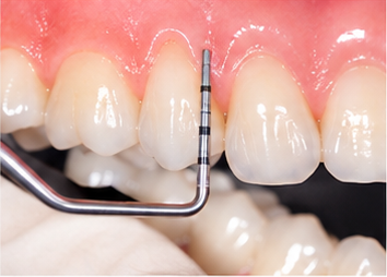Periodoncia